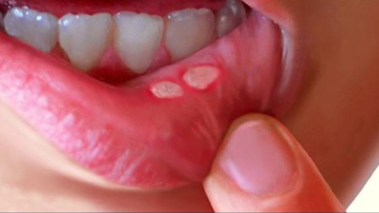 Mouth ulcers: మాటిమాటికీ మౌత్ అల్సర్స్ వస్తున్నాయా? నోటి పూతే కదా అని లైట్ తీసుకుంటున్నారా? Mouth ulcers: మాటిమాటికీ మౌత్ అల్సర్స్ వస్తున్నాయా? నోటి పూతే కదా అని లైట్ తీసుకుంటున్నారా?