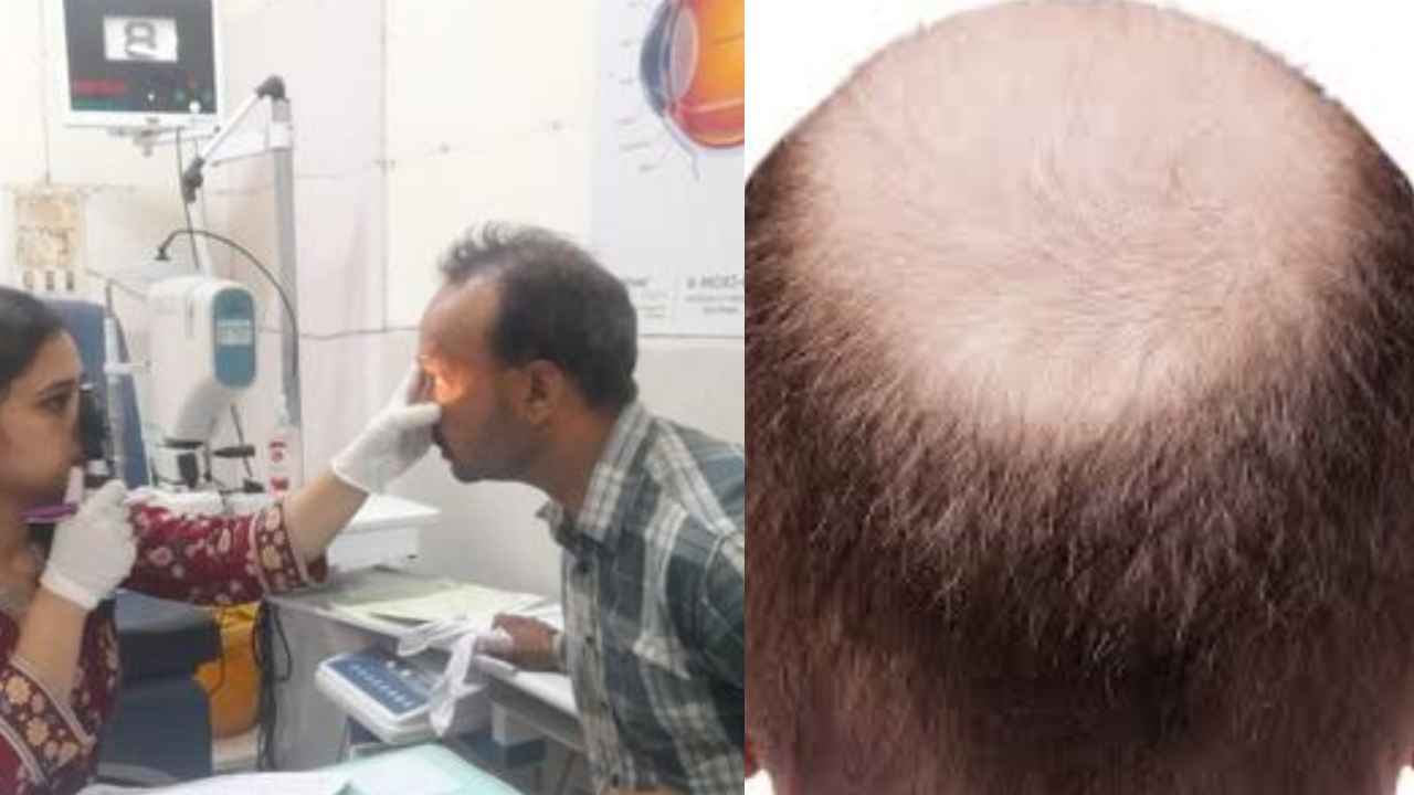 Hair Treatment Camp : ఎంత పని జరిగిందిరా అయ్యా.. బట్టతలపై జుట్టు మొలుస్తుందని ఆ నూనె వాడారు.. చివరికి ఇలా.. Hair Treatment Camp : ఎంత పని జరిగిందిరా అయ్యా.. బట్టతలపై జుట్టు మొలుస్తుందని ఆ నూనె వాడారు.. చివరికి ఇలా..