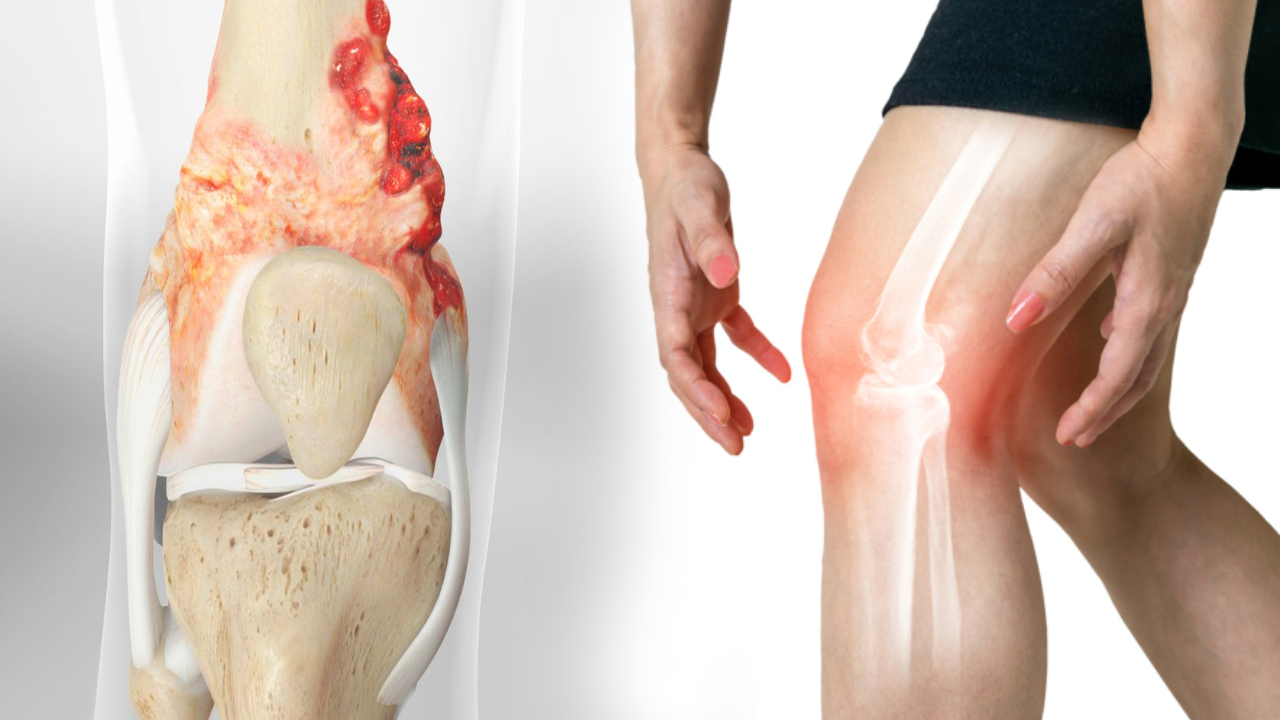 Bone Cancer: భయపెడుతున్న బోన్ క్యాన్సర్.. లక్షణాలు ఇవే.. జాగ్రత్తపడకుంటే అంతే సంగతులు Bone Cancer: భయపెడుతున్న బోన్ క్యాన్సర్.. లక్షణాలు ఇవే.. జాగ్రత్తపడకుంటే అంతే సంగతులు