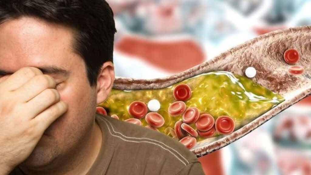 High Cholesterol Diet