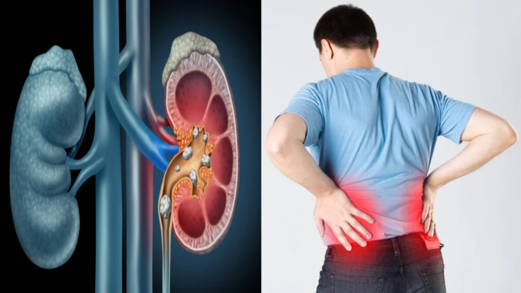 Symptoms of kidney stones