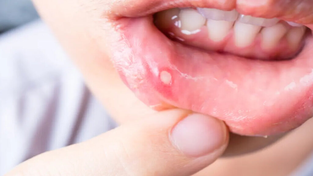 Mouth Ulcers Tips
