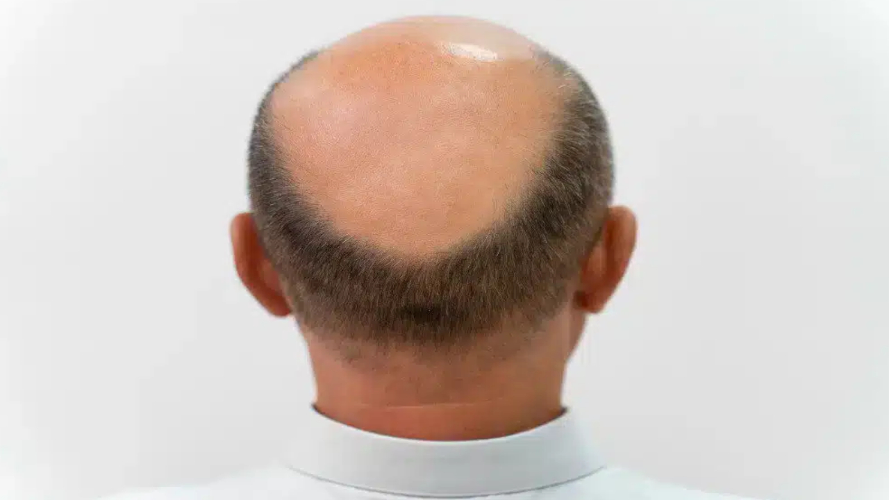 Hair Health Tips: బట్టతల బాధిస్తోందా.. అరటి ఆకులతో ఇలా చేయండి.. మంచి ఫలితాలు Hair Health Tips: బట్టతల బాధిస్తోందా.. అరటి ఆకులతో ఇలా చేయండి.. మంచి ఫలితాలు