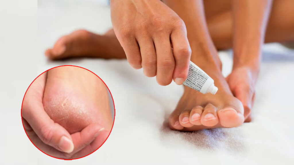 Prevention of fungal infections of the feet during the rainy season