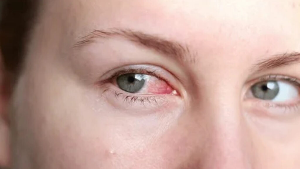 Cause of itchy eyes