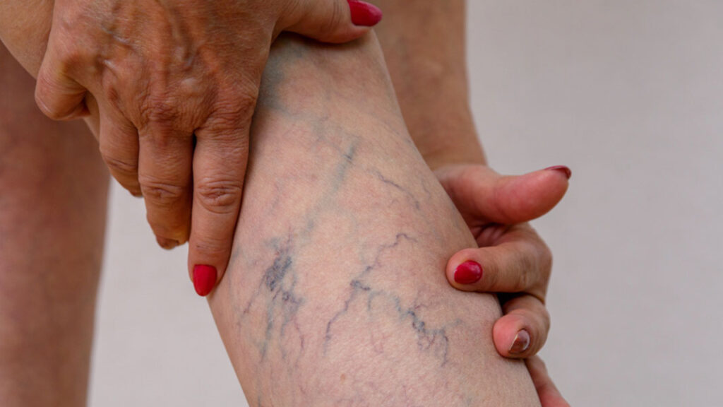 These are must-follow tips to prevent varicose veins