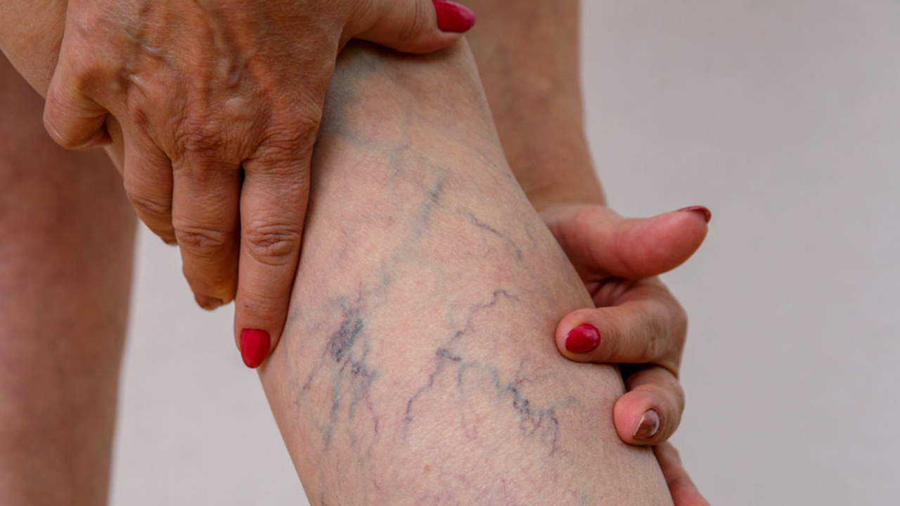 Varicose Veins: వెరికోస్ సమస్యను నిర్లక్ష్యం చేయకండి.. ఈ జాగ్రత్తలు తప్పనిసరి.. లేదంటే సర్జరీలు, లక్షల్లో ఖర్చు ఖాయం Varicose Veins: వెరికోస్ సమస్యను నిర్లక్ష్యం చేయకండి.. ఈ జాగ్రత్తలు తప్పనిసరి.. లేదంటే సర్జరీలు, లక్షల్లో ఖర్చు ఖాయం