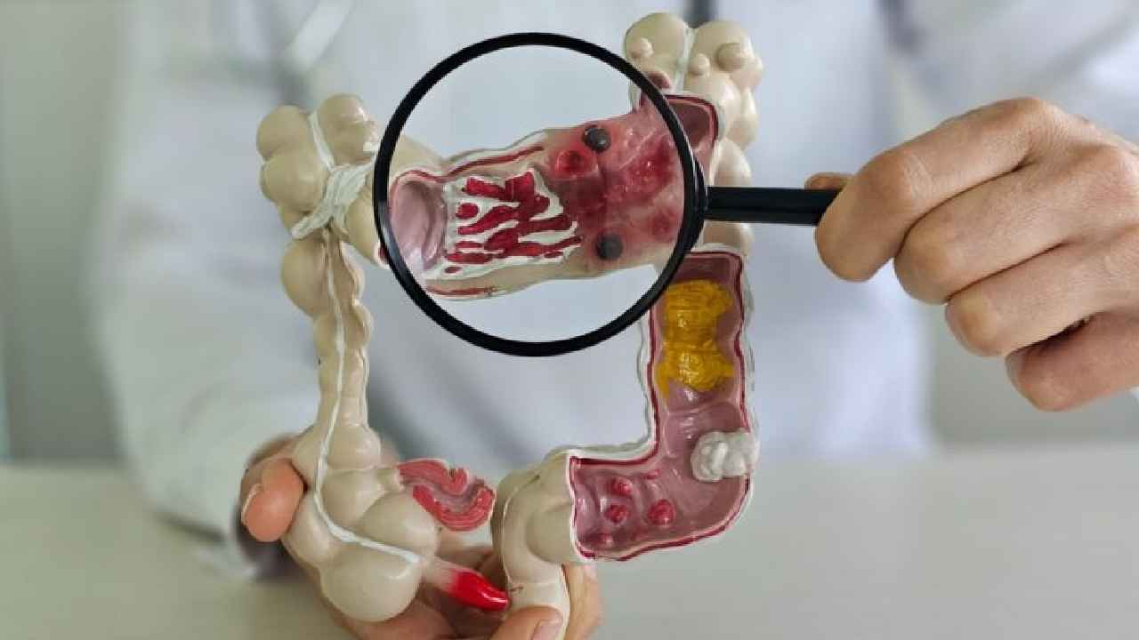 Colon Cancer: యువతకు డేంజర్ బెల్స్.. పెరుగుతున్న ఆ రకం క్యాన్సర్ కేసులు.. ఈ 5 హెచ్చరిక లక్షణాలు అస్సలు విస్మరించొద్దు.. Colon Cancer: యువతకు డేంజర్ బెల్స్.. పెరుగుతున్న ఆ రకం క్యాన్సర్ కేసులు.. ఈ 5 హెచ్చరిక లక్షణాలు అస్సలు విస్మరించొద్దు..
