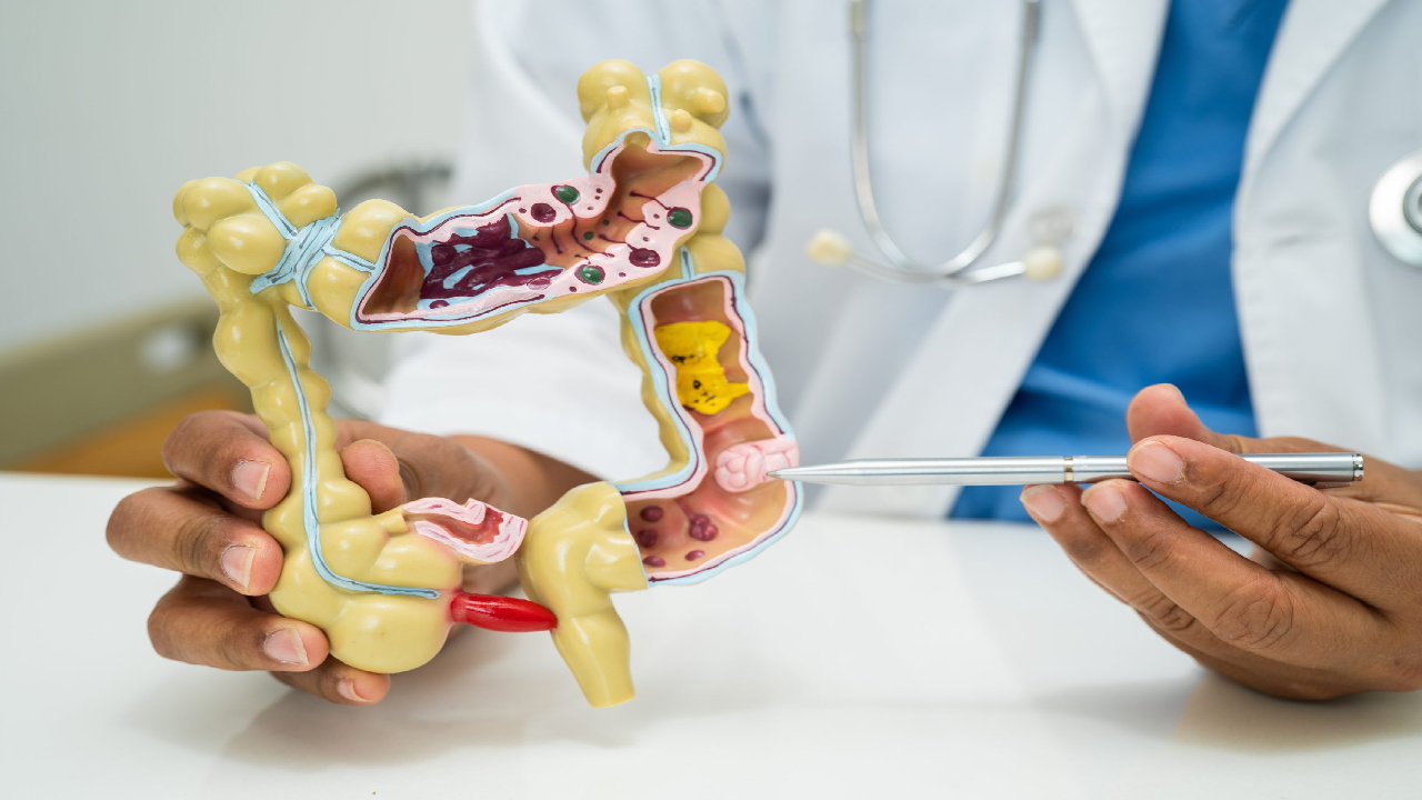 Colon Cancer: కోలన్ క్యాన్సర్ అంటే ఏమిటి.. ప్రమాద స్థాయి ఎంత.. తీసుకోవాల్సిన జాగ్రత్తలు Colon Cancer: కోలన్ క్యాన్సర్ అంటే ఏమిటి.. ప్రమాద స్థాయి ఎంత.. తీసుకోవాల్సిన జాగ్రత్తలు