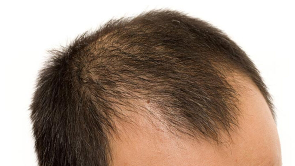 Is hair loss due to alopecia? What is the cause?