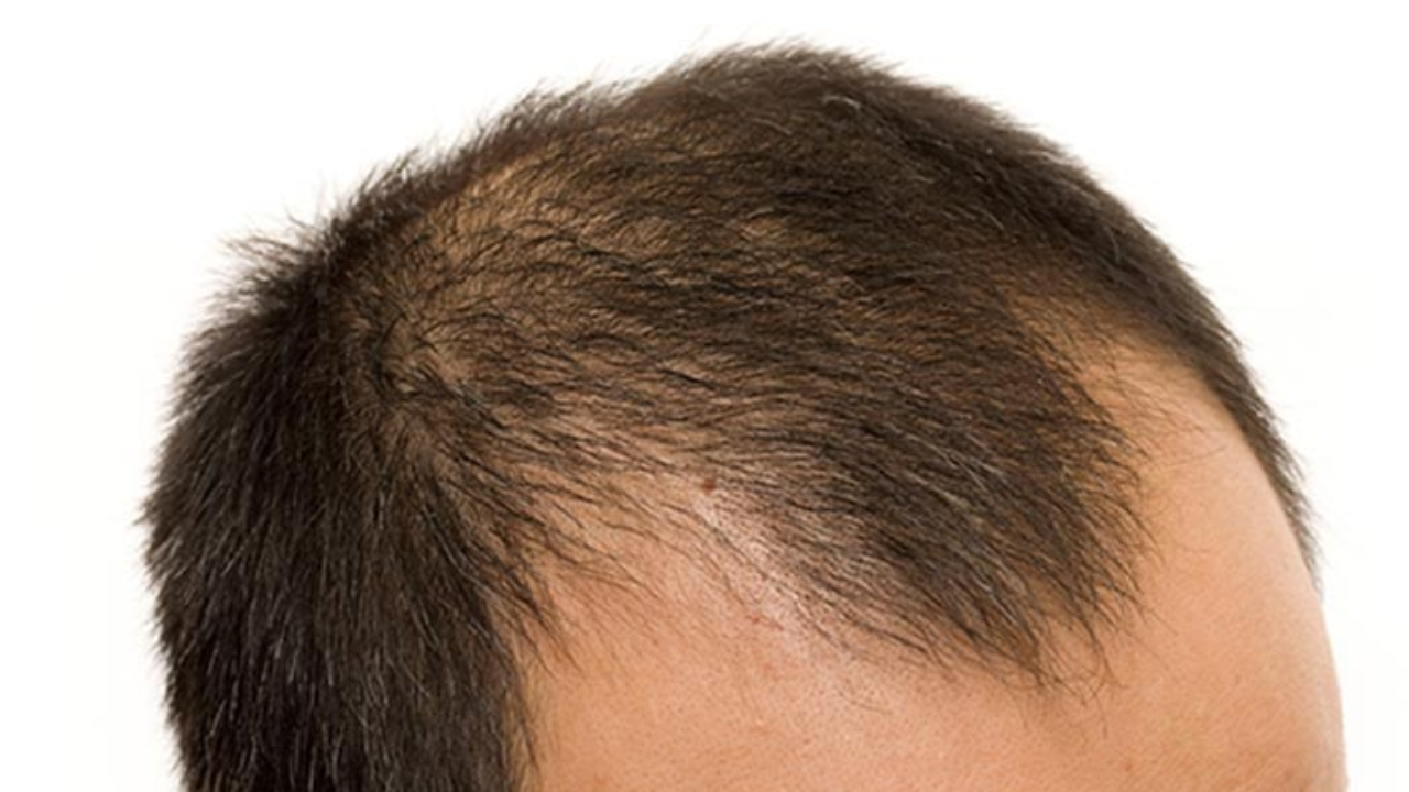 Alopecia Effects: అలోపేసియాతో జుట్టు మొత్తం రాలిపోతుంది.. అస్సలు నిర్లక్ష్యం చేయకండి Alopecia Effects: అలోపేసియాతో జుట్టు మొత్తం రాలిపోతుంది.. అస్సలు నిర్లక్ష్యం చేయకండి