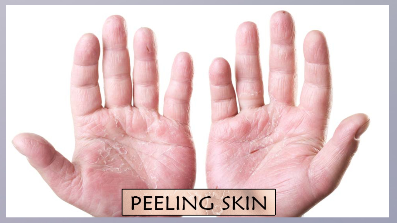 Peeling Skin: చేతల్లో చర్మం రాలిపోతుందా.. అయితే మీ ఆరోగ్యం సరిగా లేనట్టే.. ఈ వ్యాధి లక్షణం కావచ్చు.. జాగ్రత్త సుమీ Peeling Skin: చేతల్లో చర్మం రాలిపోతుందా.. అయితే మీ ఆరోగ్యం సరిగా లేనట్టే.. ఈ వ్యాధి లక్షణం కావచ్చు.. జాగ్రత్త సుమీ