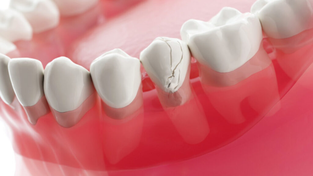 Preventive measures to prevent cracks between teeth
