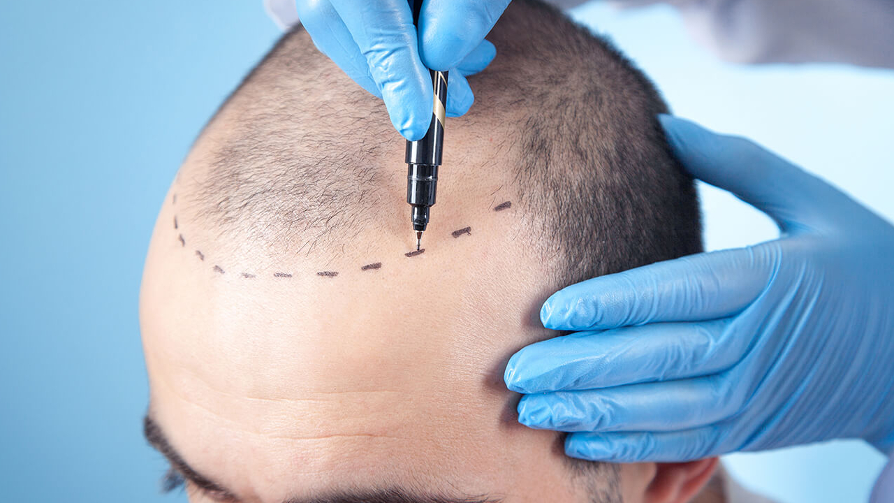 Hair Transplantation: బట్టలతకు హెయిర్ ట్రాన్స్ప్లాంటేషన్ సరైనదేనా? ఇది ఎలా చేస్తారు.. నిజంగా జుట్టు వస్తుందా Hair Transplantation: బట్టలతకు హెయిర్ ట్రాన్స్ప్లాంటేషన్ సరైనదేనా? ఇది ఎలా చేస్తారు.. నిజంగా జుట్టు వస్తుందా