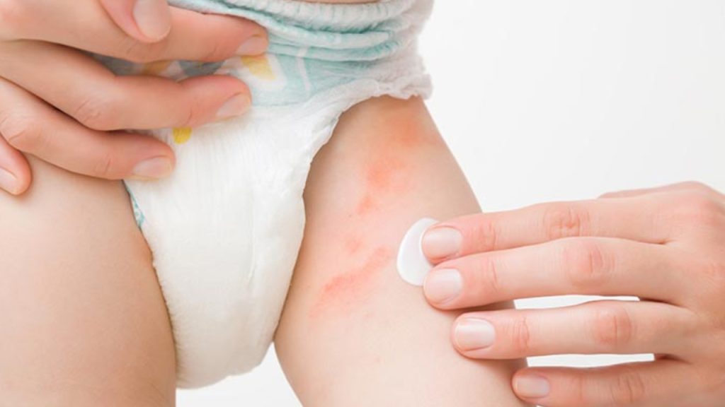 Kids Health: 5 tips to reduce diaper rashes in children sn