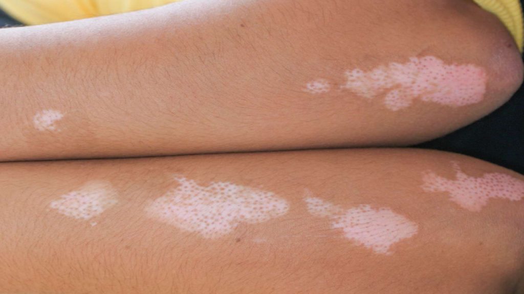 What are the main causes of white spots on the skin?