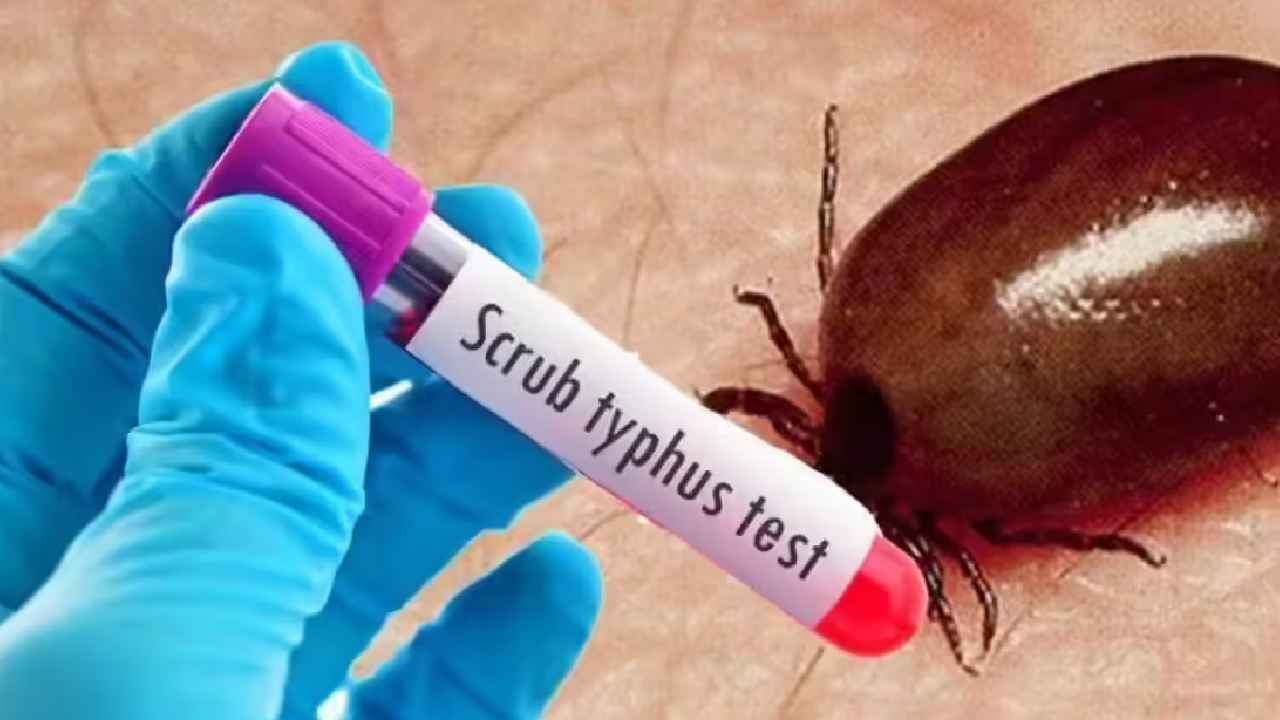 Scrub Typhus Case: ఏపీలో స్క్రబ్ టైఫస్ వ్యాధి కలకలం.. ఏలూరులో మరో కేసు నమోదు..