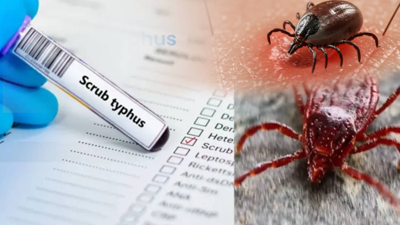 Scrub Typhus : ఏపీని హడలెత్తిస్తున్న స్ర్కబ్ టైఫస్.. 22మంది మృతి.. ఈ జిల్లాల్లోనే ప్రభావం ఎక్కువ..